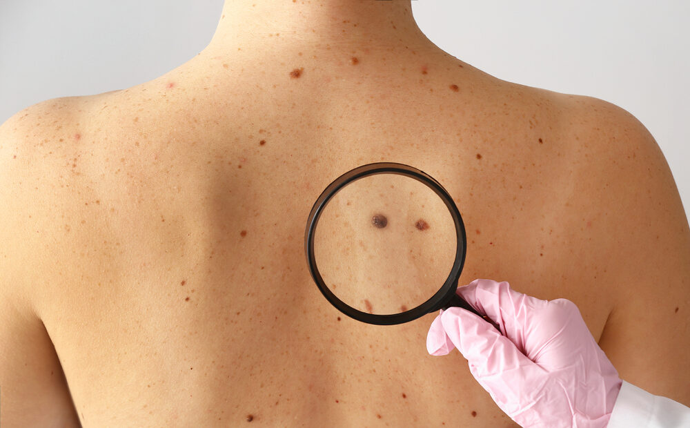 Dermatologist,Examining,Moles,Of,Patient,In,Clinic