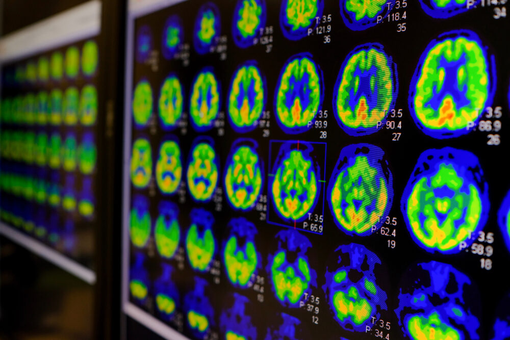 Pet,Ct,Scan,Of,Human,Brain,(axial,View,Positron,Emission
