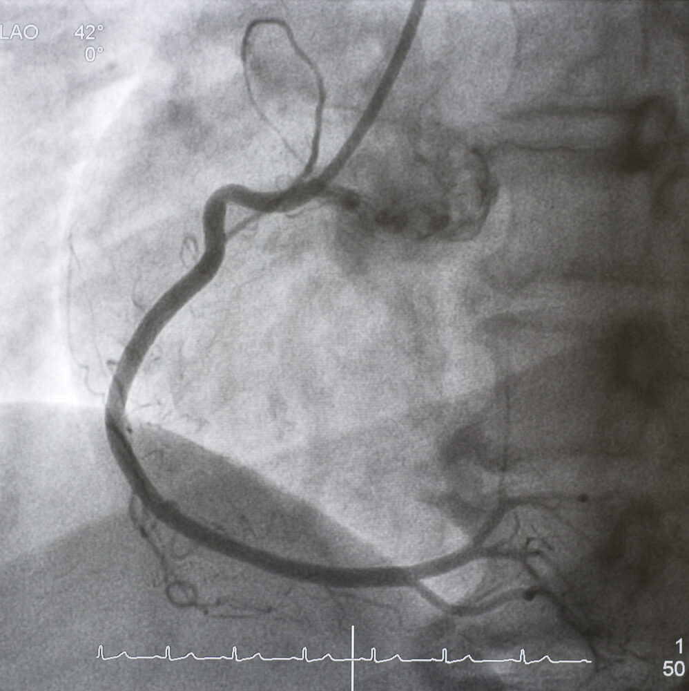 Coronary,Angiogram,(cag),Was,Performed,Right,Coronary,Artery,(rca)