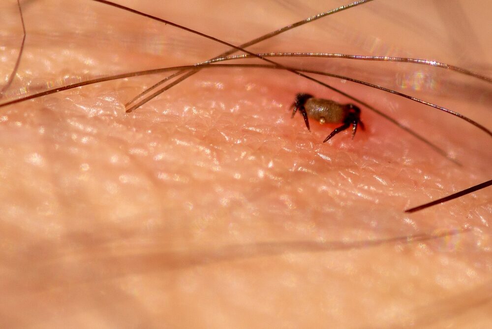 Human,Being,Bitten,By,A,Tick