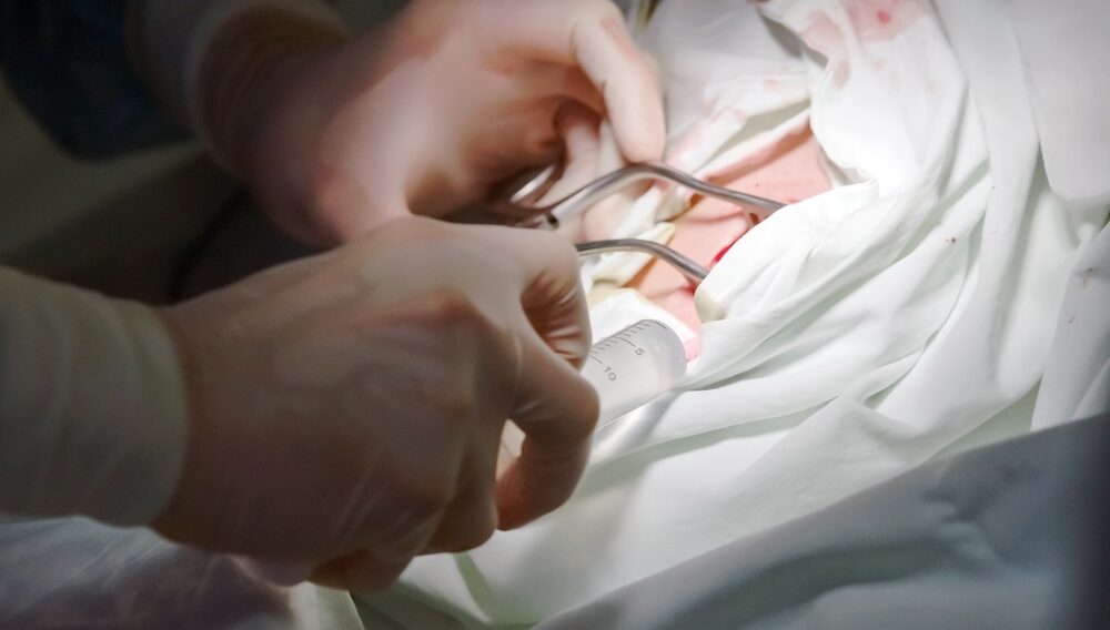 The,Actual,Operation,To,Install,A,Pacemaker,,Incision.